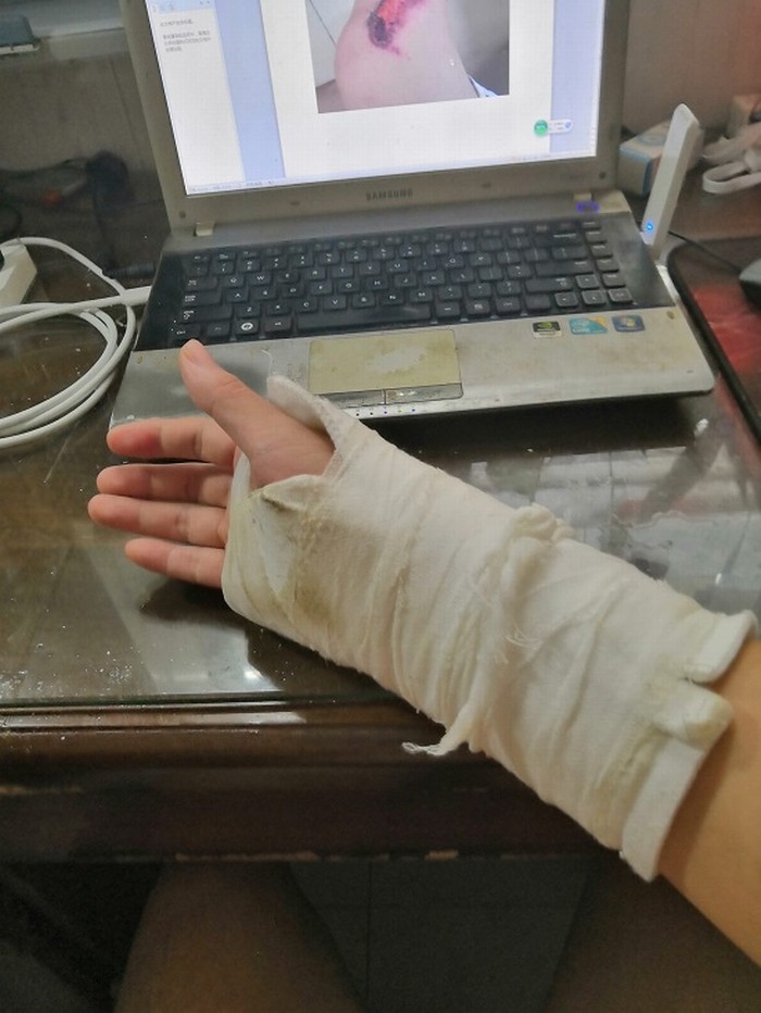 胡正军的右手被警察反背到后面,用约束带捆上,导致挠骨骨裂、胸部肋骨骨裂。(受访者提供).jpg 胡正军的右手被警察反背到后面,用约束带捆上,导致挠骨骨裂、胸部肋骨骨裂。(受访者提供).jpg