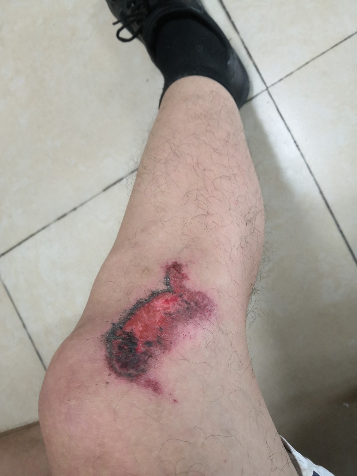 胡正军遭到警察殴打,导致身上多处受伤。(受访者提供) 1.jpg 胡正军遭到警察殴打,导致身上多处受伤。(受访者提供) 1.jpg