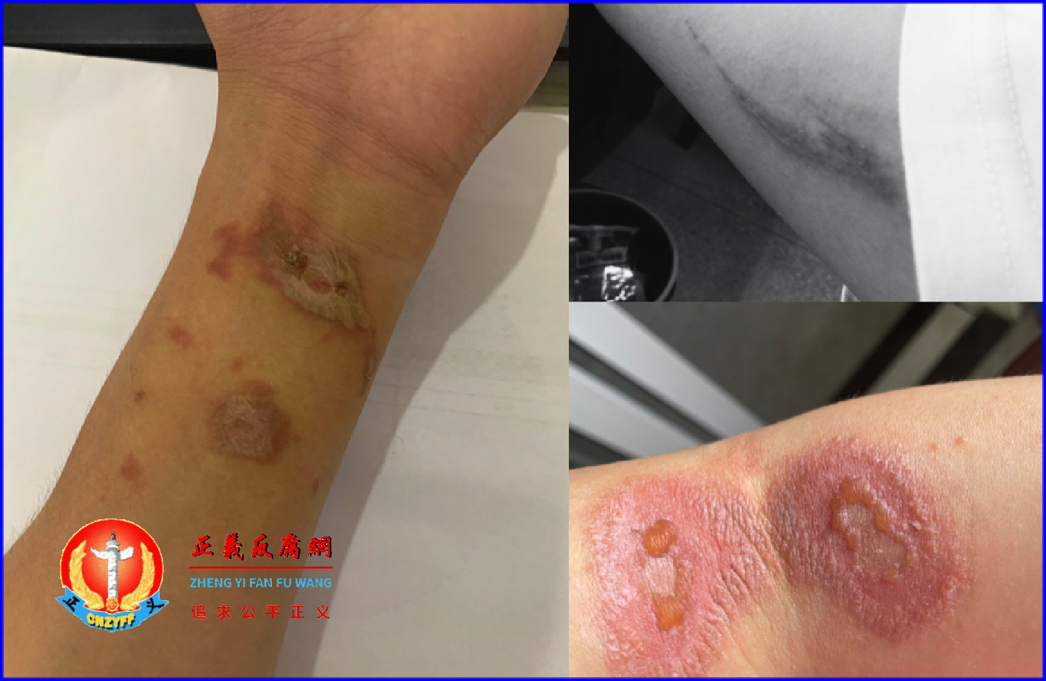 2023年9月,全国多地网民发图片透露自己被隐翅虫叮咬后的情况。.png 2023年9月,全国多地网民发图片透露自己被隐翅虫叮咬后的情况。.png