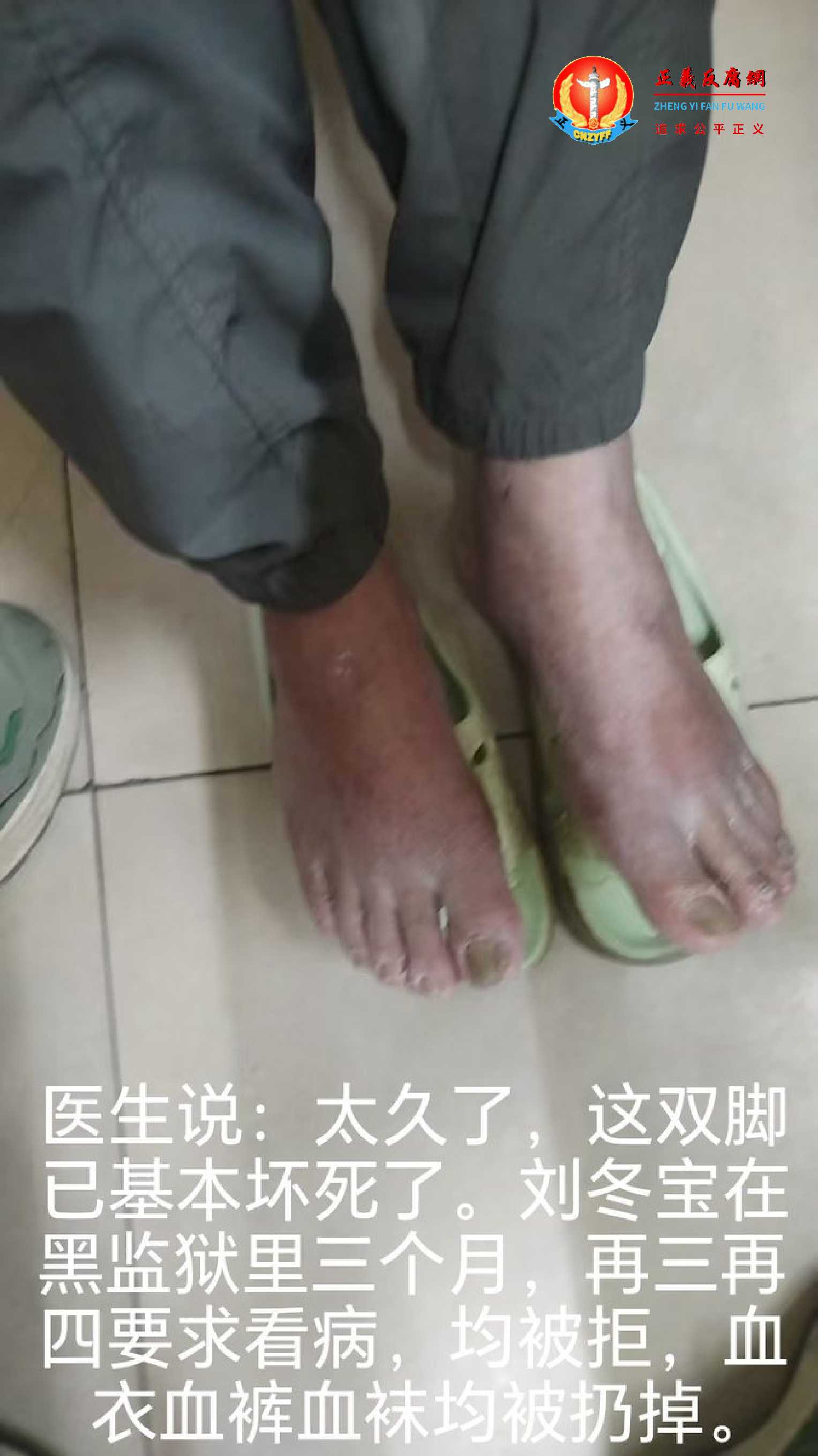 访民刘冬宝在黑监狱里三个月,再三再四要求看病,均被拒,血衣血裤血袜均被扔掉。医生说:“太久了,这双脚已基本坏死了。”.jpg 访民刘冬宝在黑监狱里三个月,再三再四要求看病,均被拒,血衣血裤血袜均被扔掉。医生说:“太久了,这双脚已基本坏死了。”.jpg